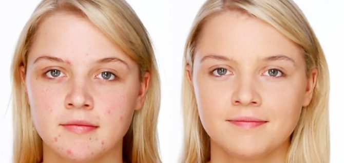 Fotografie pred a po liečbe akné pasty