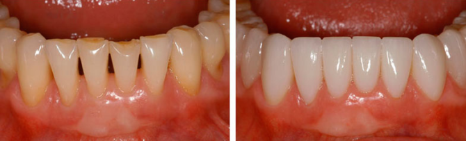 Foton före och efter installation av fanér på nedre tänder