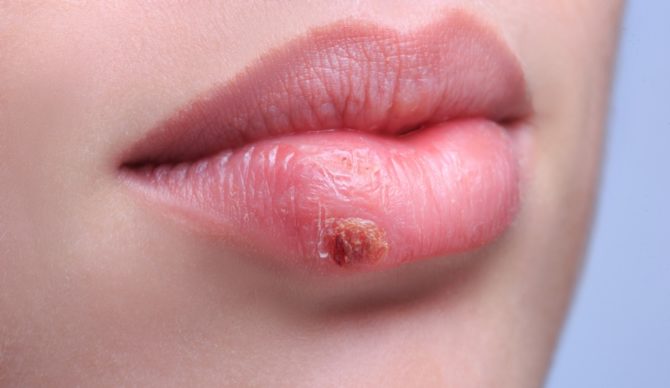 Herpes en los labios