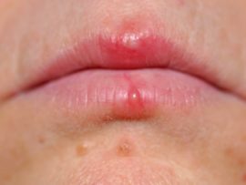 Herpes auf den Lippen