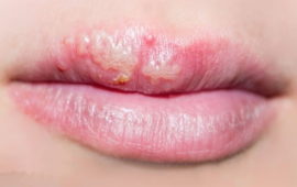 Herpes di bibir