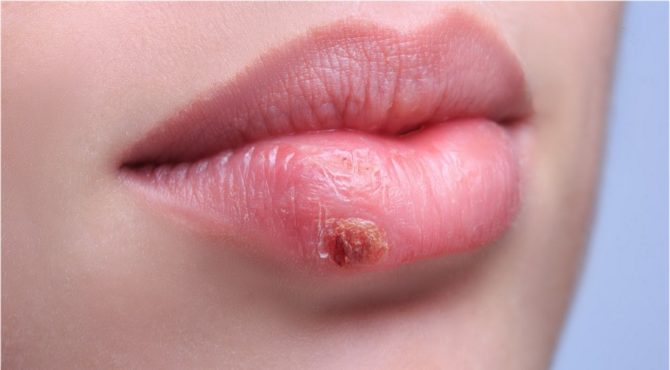 Herpes auf den Lippen