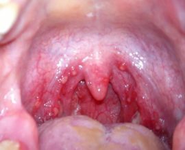 Herpes en las amígdalas