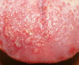 Herpes på tungan