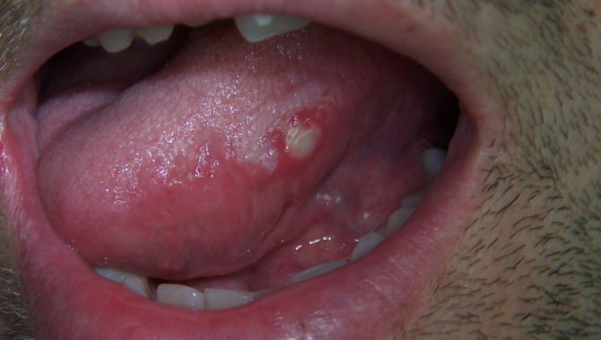 Herpes en la lengua