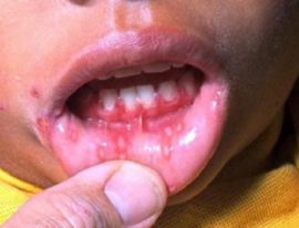 Herpes na boca da criança