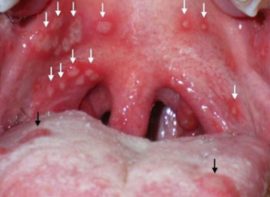 Herpes dureri în gât