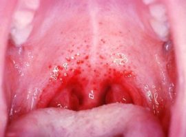 Herpetic sore throat