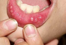 Herpetic aphthous stomatitis