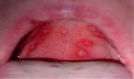 Herpeszes szájgyulladás