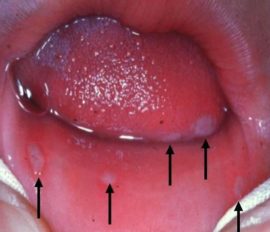 التهاب الفم الهربسي