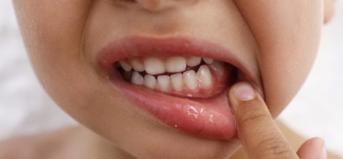 Zahnfleischentzündung