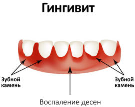 Gingivitis on the gums