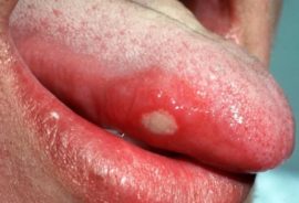 Glossitis of the tongue