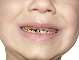 Zkažené listnaté zuby