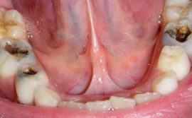 Rotten teeth in an adult