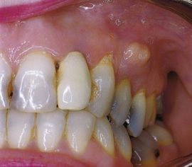 Ant dantenų esantis abscesas su periodontitu