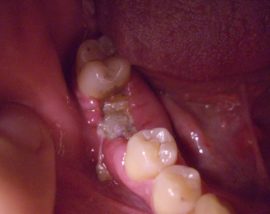Inflamación purulenta del agujero después de la extracción del diente.