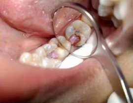 Granuloma en el diente
