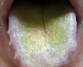 Pilzinfektion der Zunge