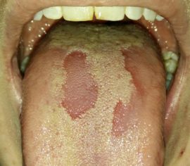 Fungal infection of the tongue