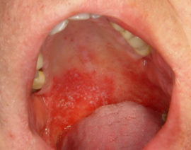 Viêm miệng nấm