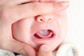 Estomatitis fúngica en un niño