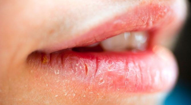 Cheilitis על השפתיים