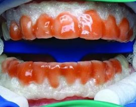 הלבנת שיניים כימיות