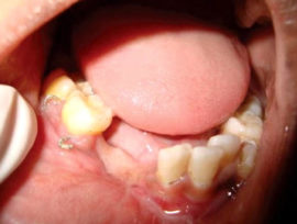 Chronic odontogenic osteomyelitis of the lower jaw