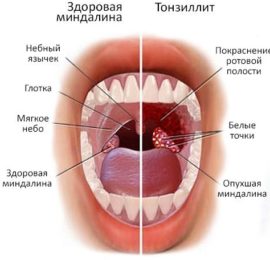 Tonsillite cronica