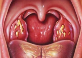 Chronic tonsillitis with purulent plugs