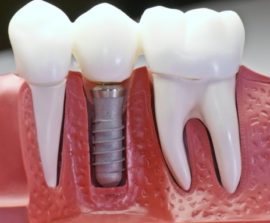 Dantų implantas