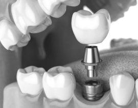 Zubna implantacija