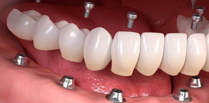 Зубни имплантати
