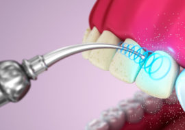 Infografikk av hvordan tannbørsting skjer med ultralyd