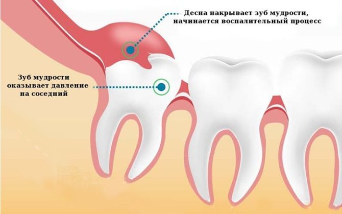 Infográficos: crescente dente do siso