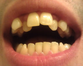 Zakrivenie zubov v dospelosti