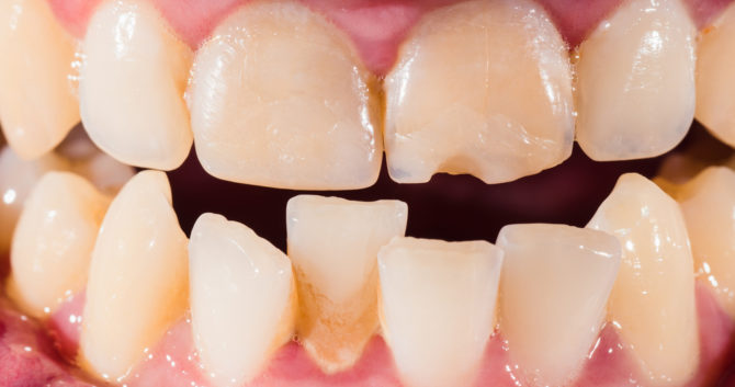 Извијени зуби