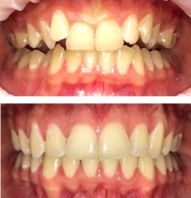 Corrección de oclusión ortodoncista