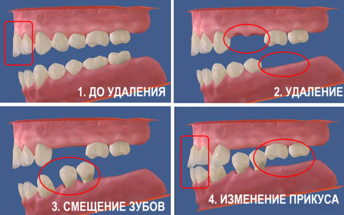 Промјена угриза након вађења зуба