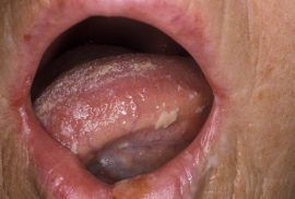 Mga oral candidiasis