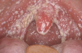 المبيضات التهاب الفم