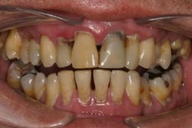 Carie et maladie parodontale