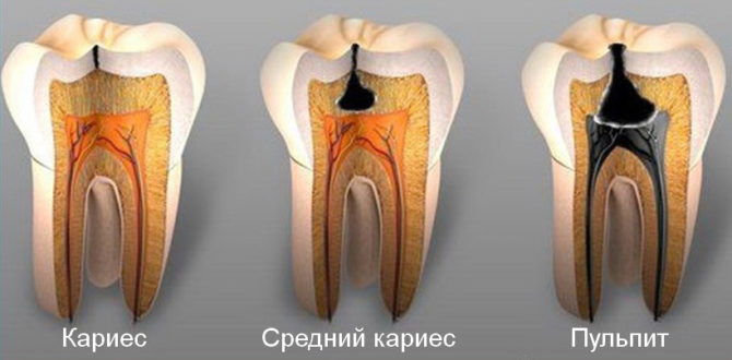 Carie dentaire et pulpite