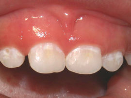 Decay of deciduous teeth