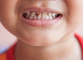 Rozpad na dětské zuby