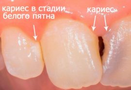 Zubní kaz v počáteční a střední fázi
