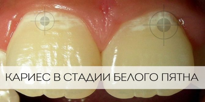 Zubní kaz ve fázi bílé skvrny