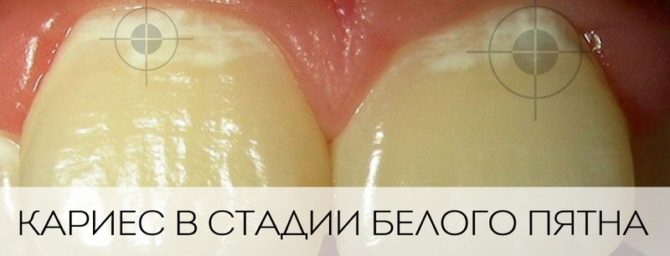 Sâu răng trong giai đoạn của một đốm trắng